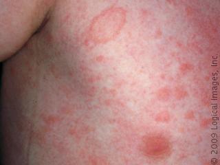 Pityriasis Rosea - Symptoms, Causes, Diagnosis & Treatment